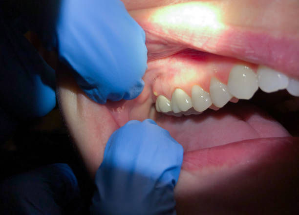 Best Chipped Tooth Repair Near Me  in Port Byron, IL